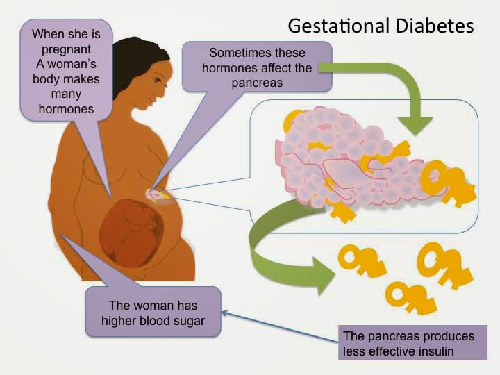 The Gestational Diabetes Screen Midwife Louisiana, LLC